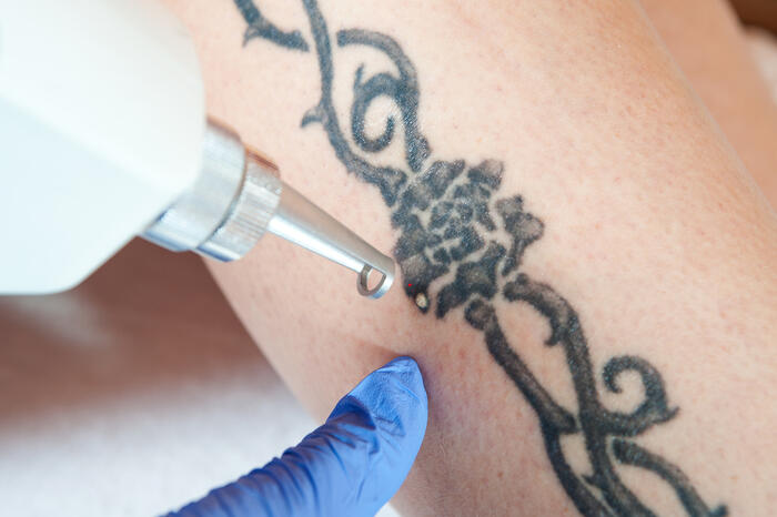 remoção de tatuagem a laser
