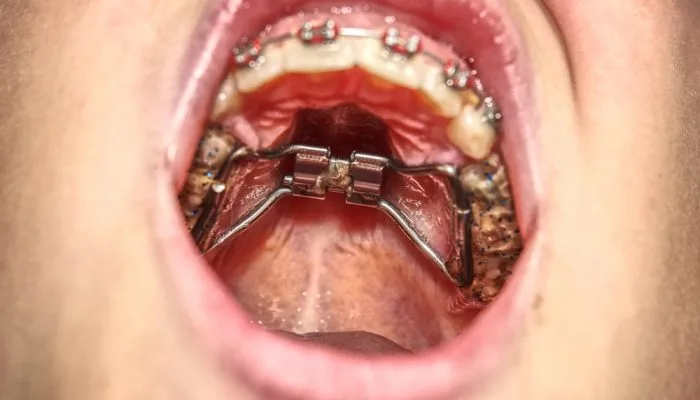 aparelho ortodôntico fixo