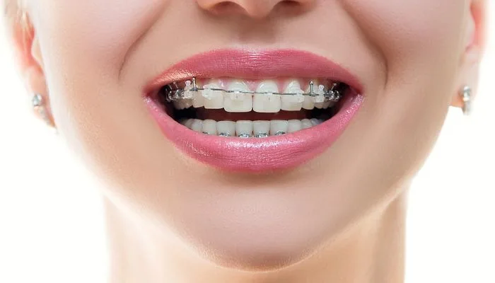 aparelho fixo estético